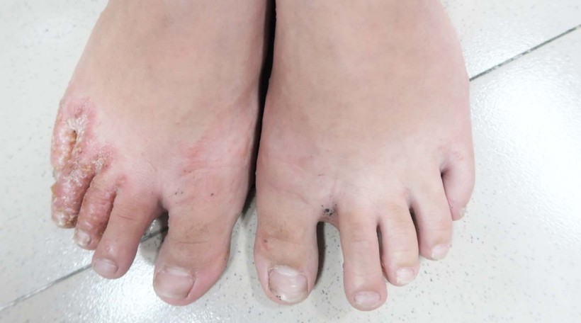 Bệnh nhân bị nấm chân (Ảnh: BS. Lê Thị Mai)