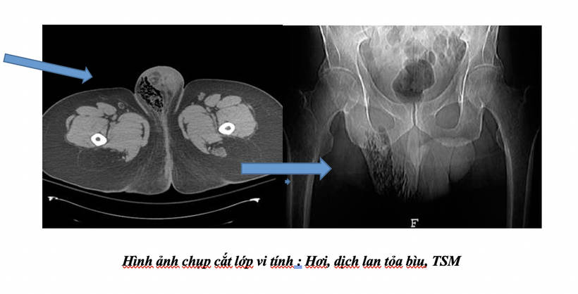 Ảnh chụp cắt lớp vi tính của bệnh nhân (Ảnh: BVCC)