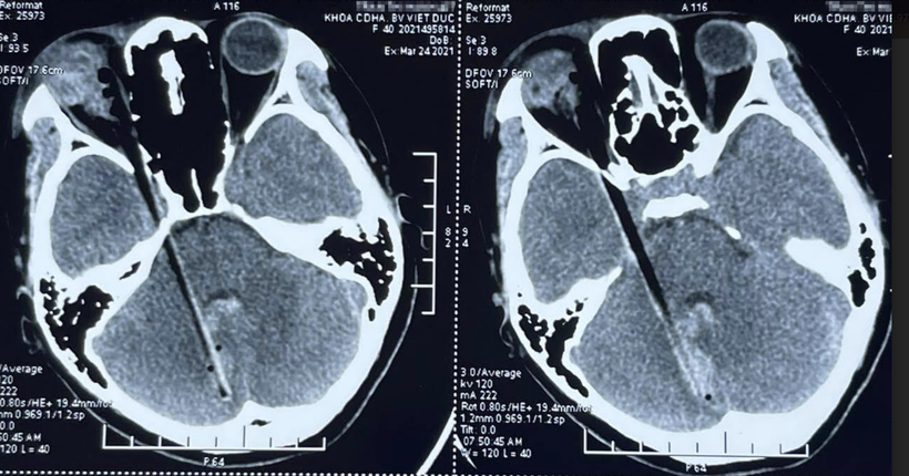 Hình ảnh dị vật đâm xuyên qua hốc mắt, vào sọ não của bệnh nhân (Ảnh - BVCC)