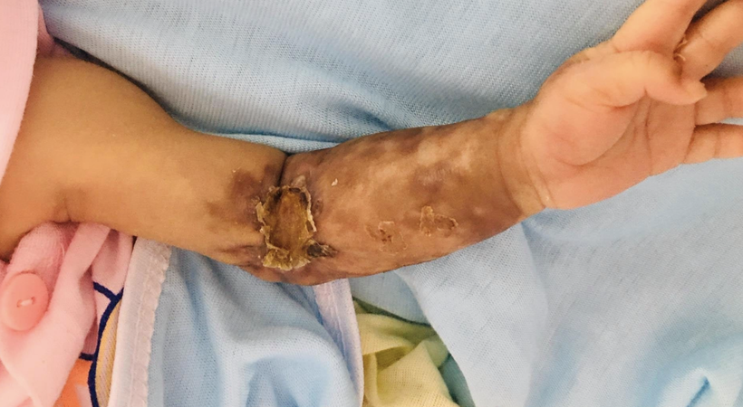 Cánh tay bé T. sau phẫu thuật (Ảnh - BVCC)