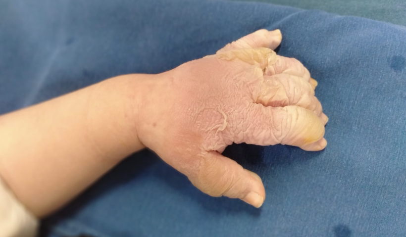 Hình ảnh bàn tay của trẻ bị bỏng nước sôi (Ảnh - BVCC) Hình ảnh bàn tay của trẻ bị bỏng nước sôi (Ảnh - BVCC)