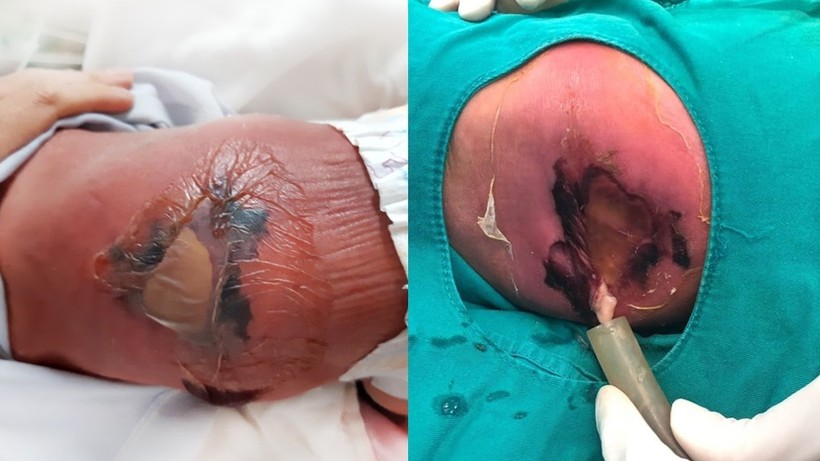 Em bé sơ sinh bị bỏng nặng, hoại tử da vì mẹ cho nằm than