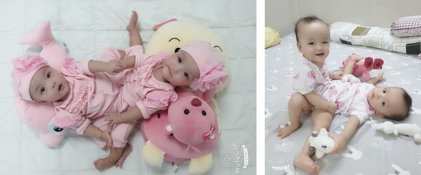 Hình ảnh Trúc Nhi - Diệu Nhi trước khi đại phẫu tách rời. Ảnh: BVCC Hình ảnh Trúc Nhi - Diệu Nhi trước khi đại phẫu tách rời. Ảnh: BVCC